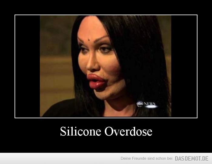 Silicone Overdose –  